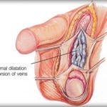 دوالي الخصية و ما هي أعراضها و تأثيرها على الإنجاب و كيفية علاجها