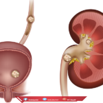 حوار طبي مع د/ حسن اسماعيل عن حصوات الكلى