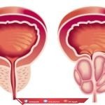 علاج تضخم البروستاتا بالاعشاب جابر القحطاني