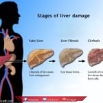 علاج ارتفاع انزيمات الكبد جابر القحطاني