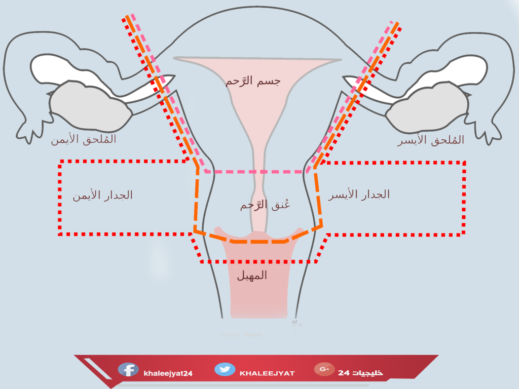 علاج نزول الرحم جابر القحطاني