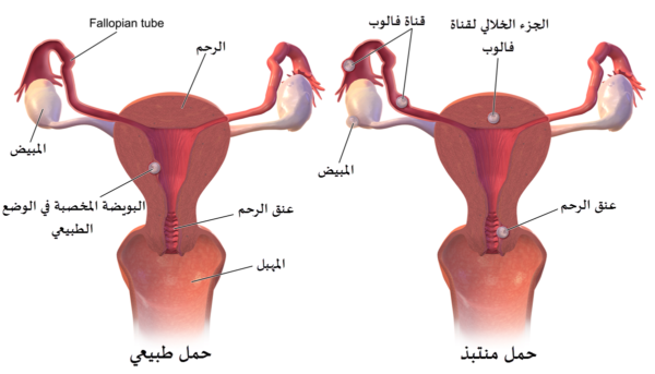 كيفية العلاج من الحمل خارج الرحم