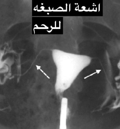 تعريف اشعة الصبغة