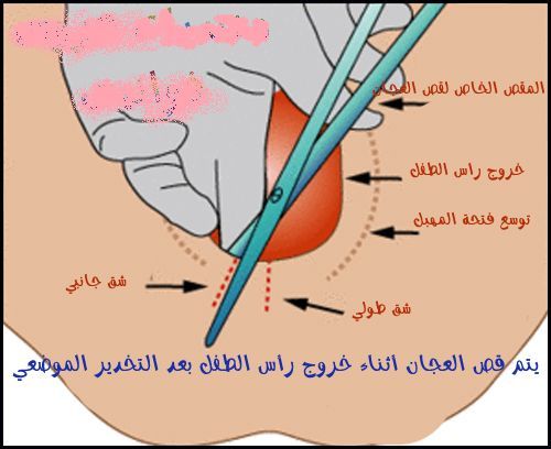 قص العجان لخروج الجنين