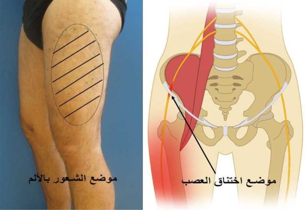 الم في اعلى الفخذ الايمن من الداخل