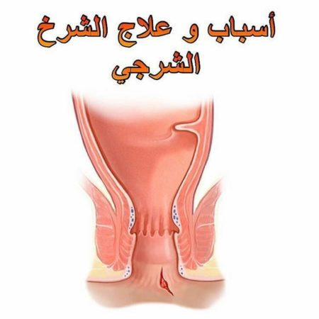 أعراض الإصابة الشرخ