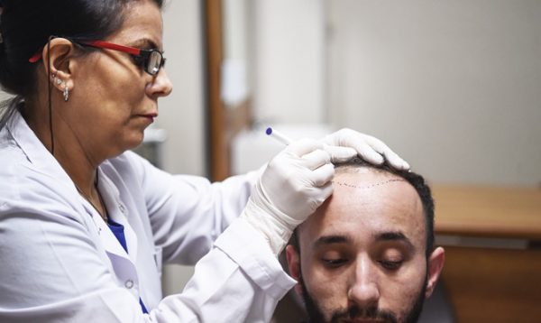 تجربتي مع زراعة الشعر في الرياض