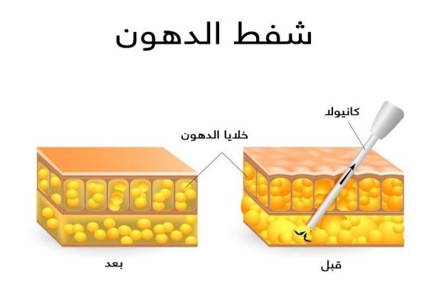 سعر شفط الدهون في ادمه