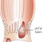 علاج البواسير بالاعشاب جابر القحطاني وافضل الوصفات الطبيعية